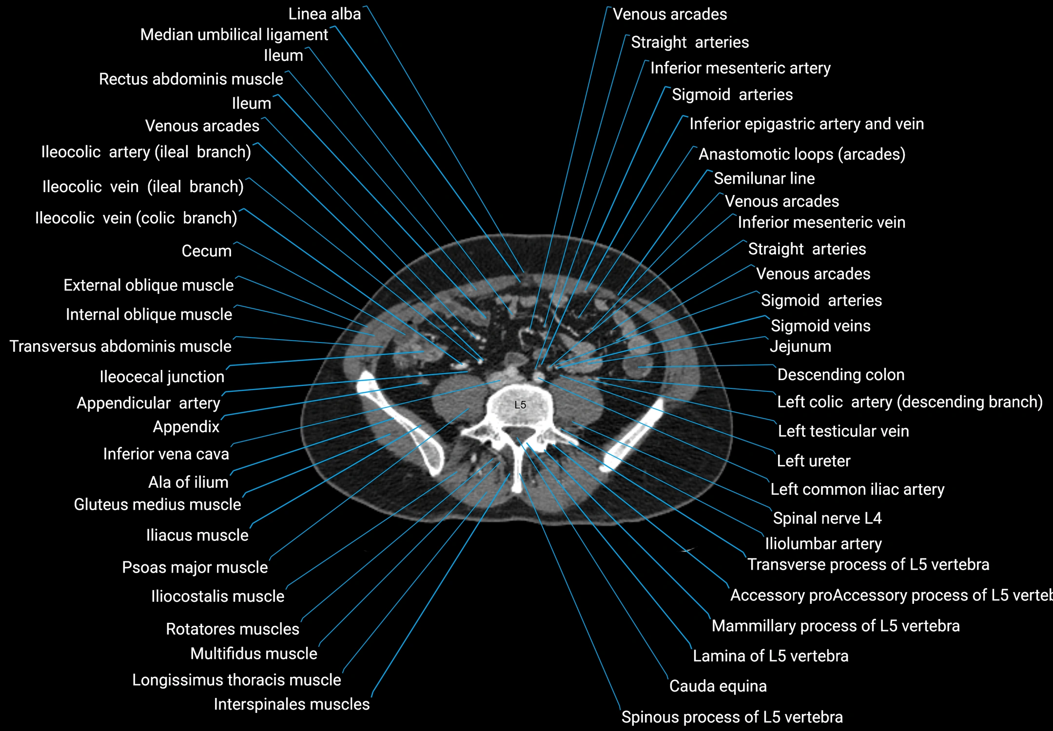 CT male pelvis axial cross sectional anatomy labelled radiology image -00123.webp